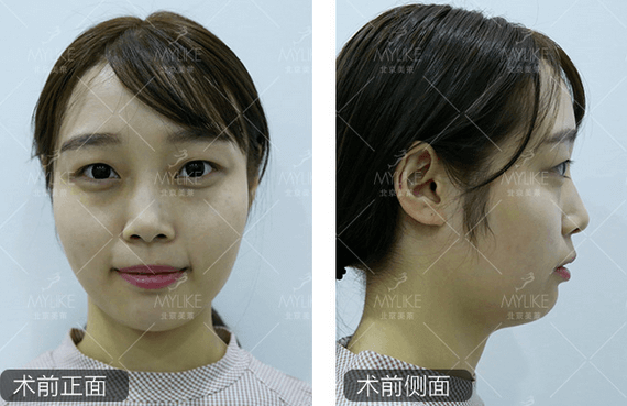 玻尿酸注射、+<a href='/bj/' target='_blank'><u>北京美萊</u></a>無創(chuàng)案例