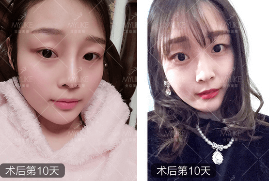 玻尿酸注射、+北京美萊無創(chuàng)案例