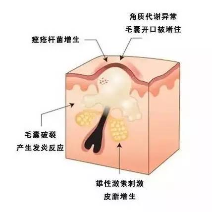 閉口和粉刺有什么區(qū)別，怎么祛除