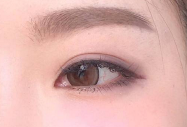 做埋線(xiàn)雙眼皮好不好呢