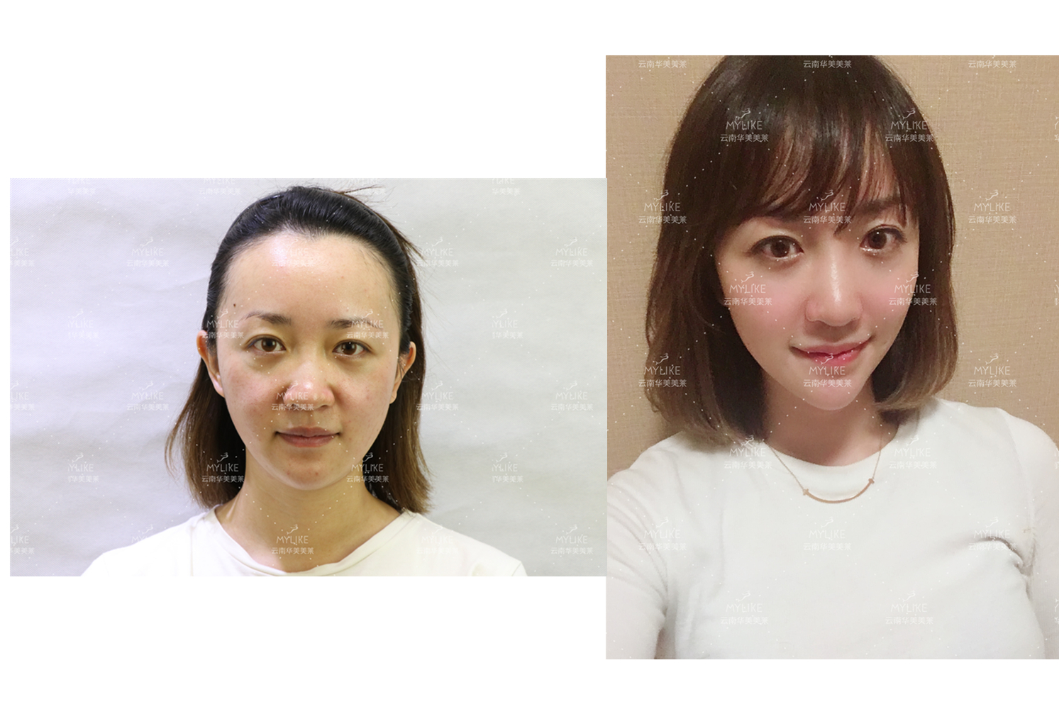 出演電視劇《官渡人家》的小姐姐必做的醫(yī)美項目！！美萊雙十一get好物推薦