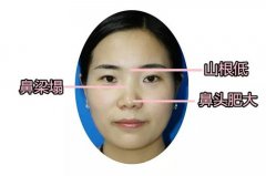 萬州做硅膠隆鼻術(shù)后硅膠能取出嗎