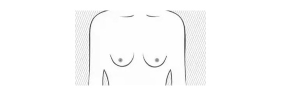 乳房再造