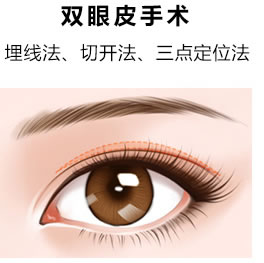 沈陽(yáng)做雙眼皮手術(shù)哪種類型比較好