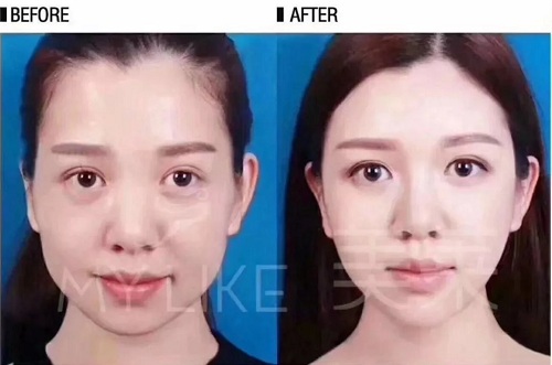 瘦臉針打三次就能真的定型嗎？？？