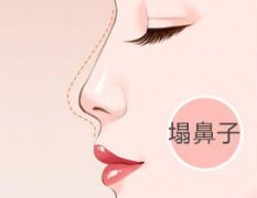 假體隆鼻的有無后后遺癥？假體隆鼻的材料有無副作用?