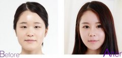 昆明做雙眼皮術(shù)后恢復(fù)快一定會變內(nèi)雙嗎？