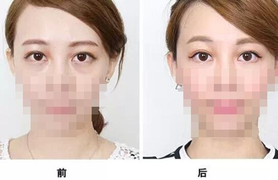 通過(guò)手術(shù)祛眼袋多久看都效果?會(huì)有疤痕嗎？