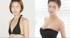 武漢自體脂肪隆胸的效果好不好？