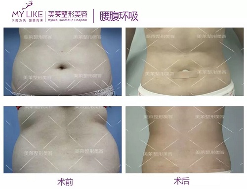 美萊醫(yī)院：據(jù)說男人都愛這種“沙漏身材”？！