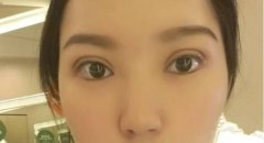 深圳做雙眼皮修復(fù)是不是很貴？