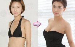 如何補救失敗的假體隆胸手術(shù)
