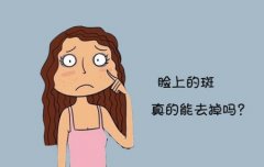 深圳激光祛斑后還會反彈？