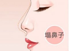 假體隆鼻怎樣預防并發(fā)癥的產生
