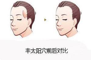 成都面部填充用什么材料比較好？