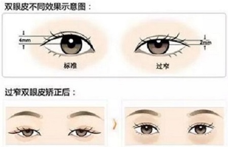 雙眼皮修復術(shù)后何時能消腫