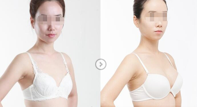 假體隆胸能夠維持多長的時(shí)間？要如何護(hù)理？