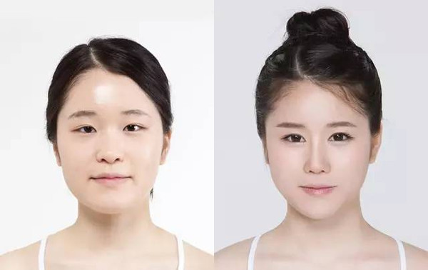 假體隆鼻術(shù)前有什么注意事項？