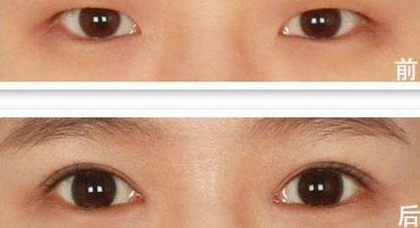 上眼瞼下垂怎么辦？