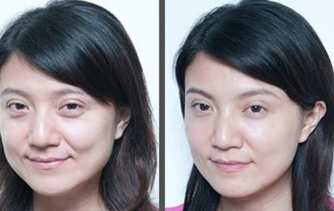 上眼瞼下垂怎么辦？