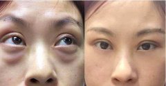 30歲就有眼袋怎么辦？
