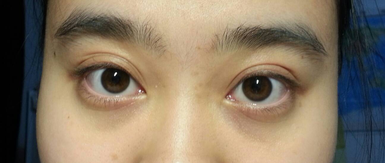 去眼袋方法都有什么？