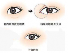 廈門做開眼角手術(shù)風險有嗎