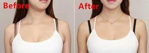 副乳怎么消除？