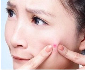 下巴上長痘痘是什么原因？怎么去除？