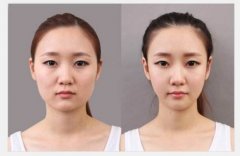 瘦臉針副作用有哪些？