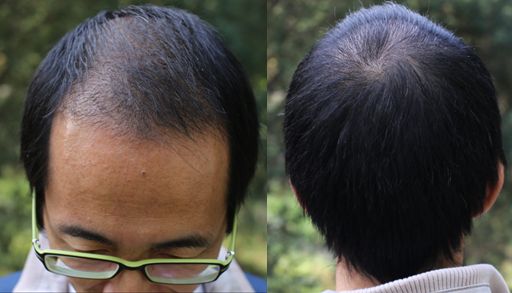 頭發(fā)種植后怎么護理？