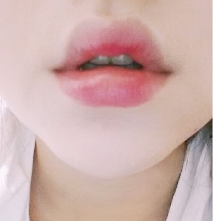用玻尿酸豐唇后怎么護(hù)理？