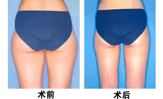 南京臀部吸脂減肥價(jià)格要多少錢(qián)？