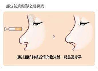 武漢注射玻尿酸隆鼻多少錢？