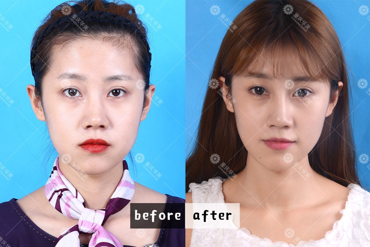 2分鐘看懂進口和國產(chǎn)瘦臉針，有什么區(qū)別？