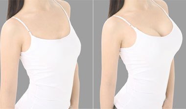 重慶自體豐胸手術(shù)價(jià)格是多少？