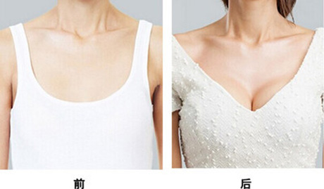 做隆胸大概費(fèi)用多少？