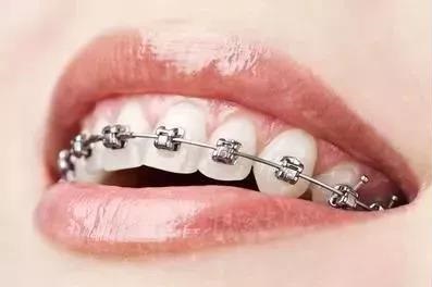 牙齒不好看？告訴你一個2小時變美的方法~