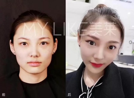想打瘦臉針，這些事你都了解了嗎？