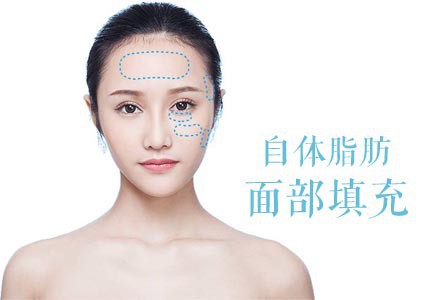 臉上填充脂肪需要多少錢(qián)？