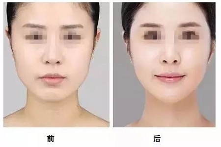 咬肌肥大，醫(yī)師卻不建議我打瘦臉針？