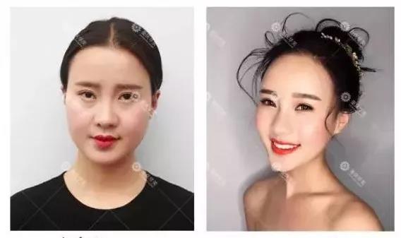 能瘦臉，又能除皺的瘦臉針，了解一下！