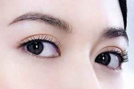 切開(kāi)法雙眼皮要多少錢