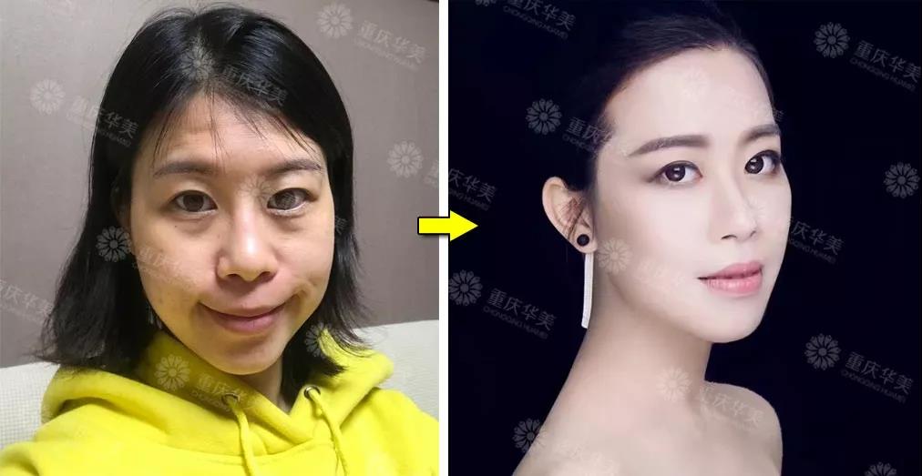 瘦臉針+玻尿酸填充，難看的法令紋、淚溝全消失！
