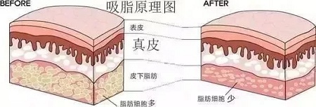 醫(yī)美白皮書：吸脂等于減肥嗎？