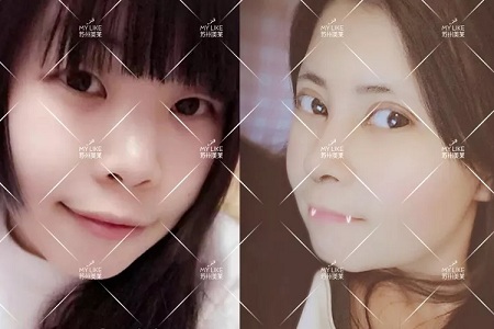 開眼角和不開眼角，差距有多大？