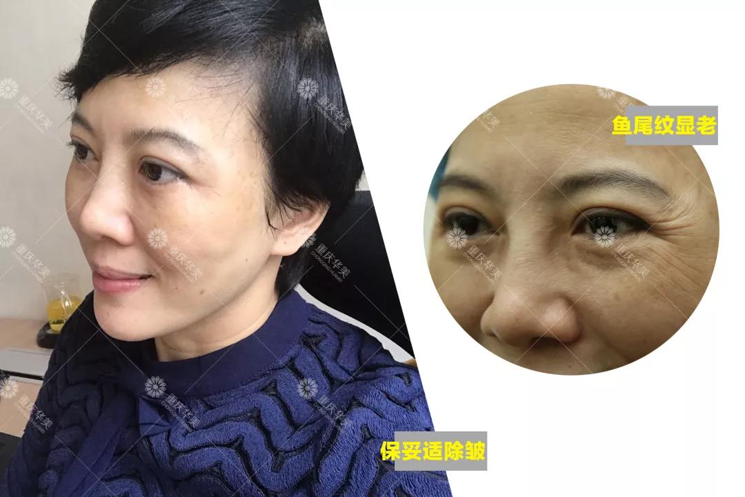 如果你是這種臉型，打瘦臉針一定有用！