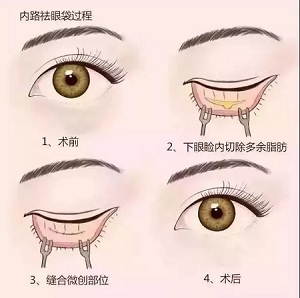 美萊實(shí)驗(yàn)室：分型祛除眼袋，拒絕+10歲