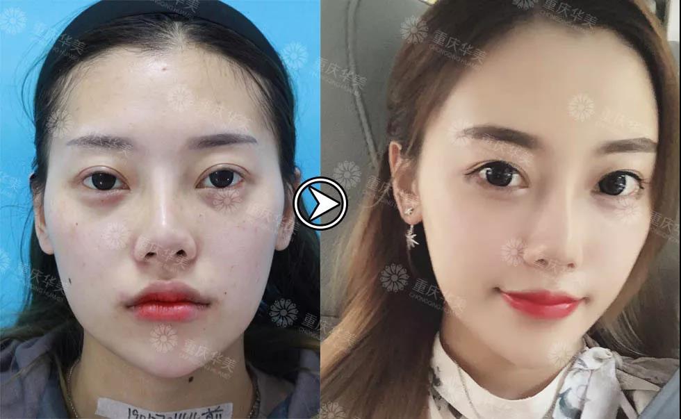 她減肥失敗100次，吸脂減肥后1個月逆襲變腿精