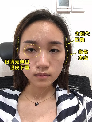 自體脂肪+雙眼皮，這對cp你不pick一下嗎？